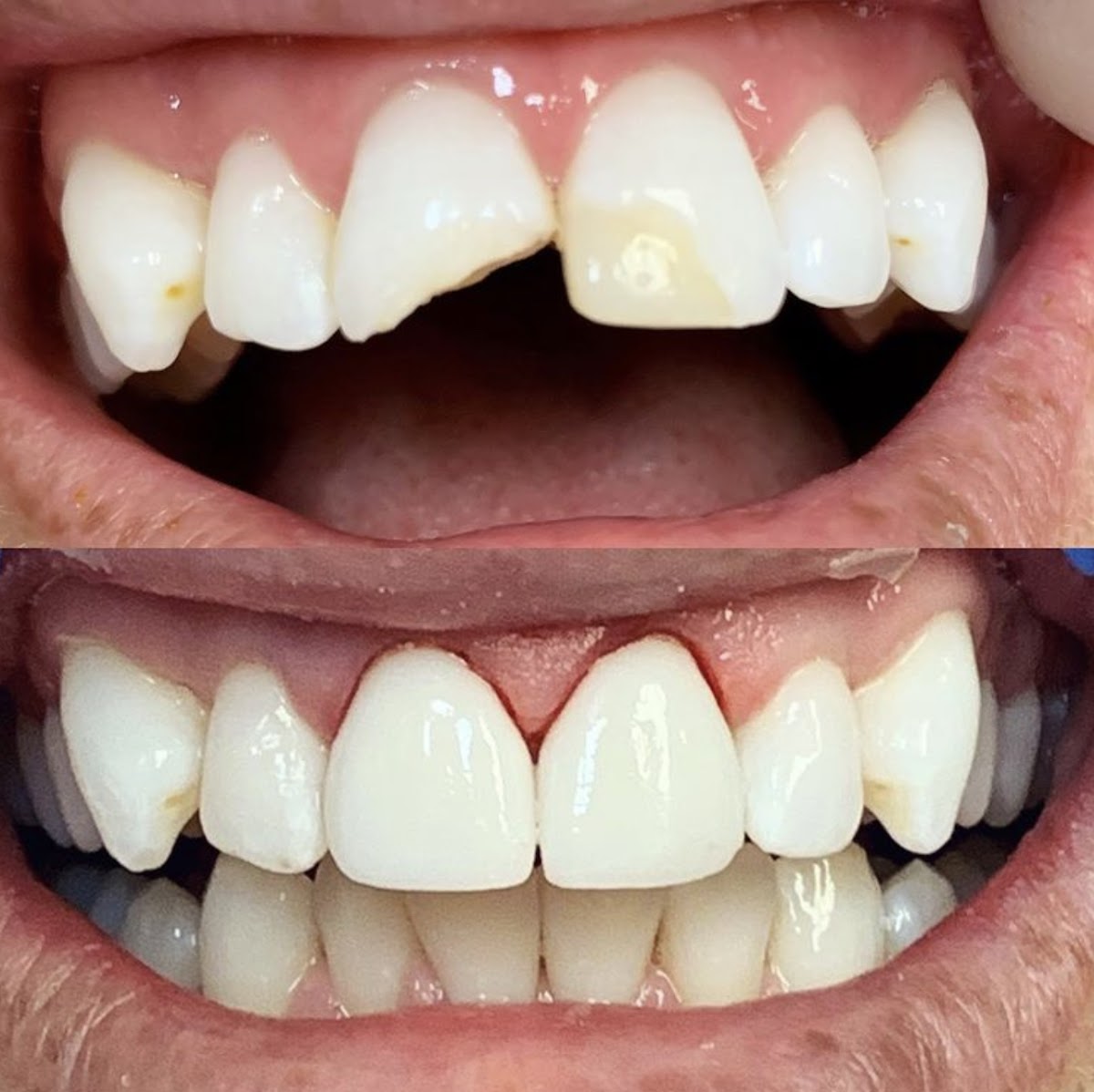 Bloomington Dental— Chris A. Neilson DDS photo 3