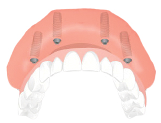 Dental Implant Solutions Sanford, Fl photo 3