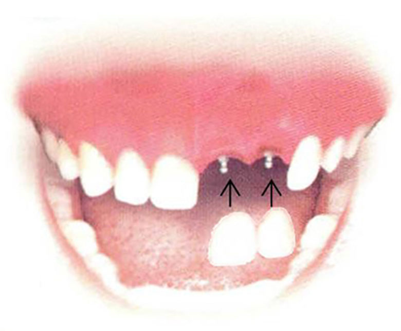 Dental Implant Solutions Sanford, Fl photo 4
