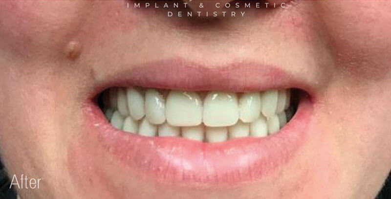 New Teeth Florida Dental Implants & Cosmetic photo 3