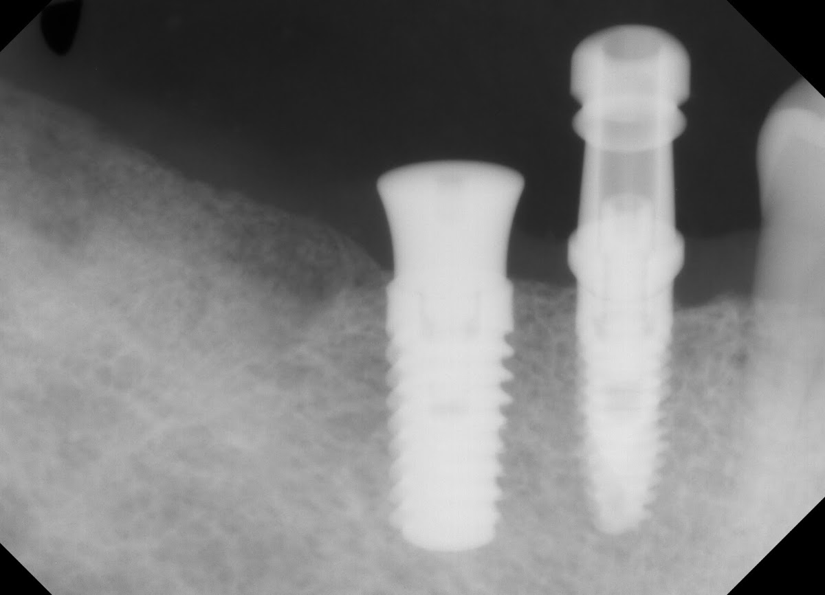 Ihex Implants photo 4