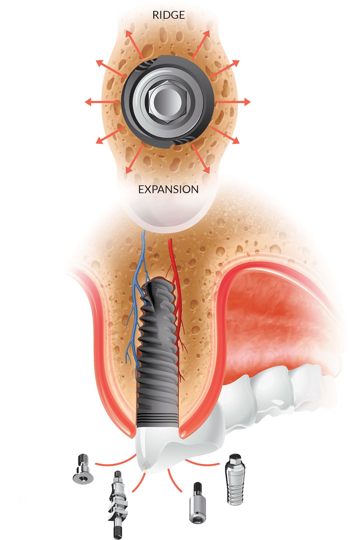 Ihex Implants photo 5