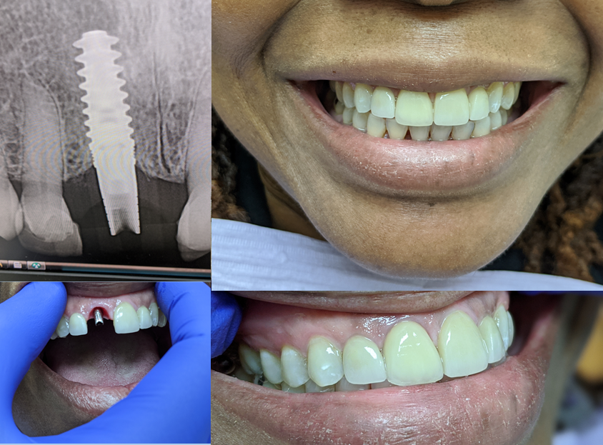 Affordable Dental Implants Long Island photo 5