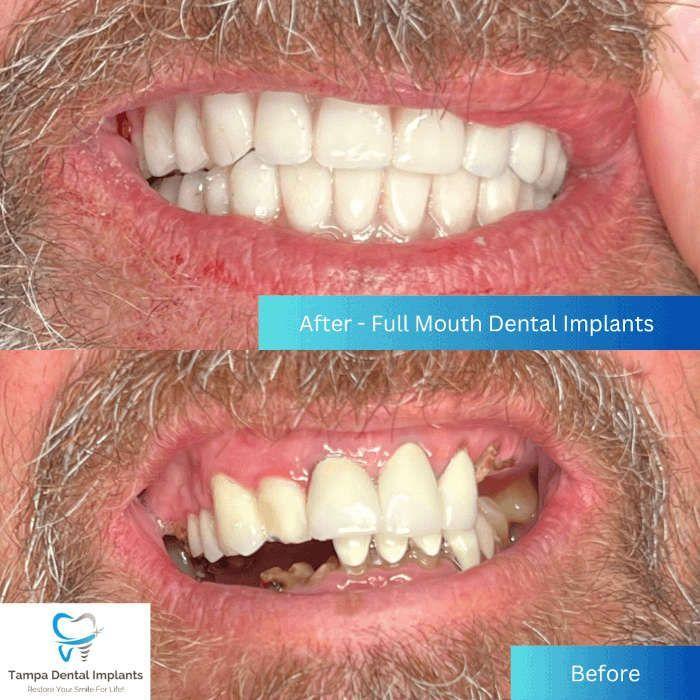 Tampa Dental Implants photo 2
