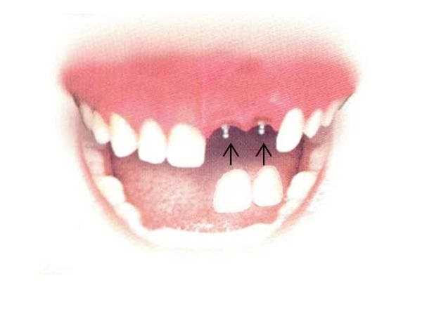 Dental Implant Solutions photo 2
