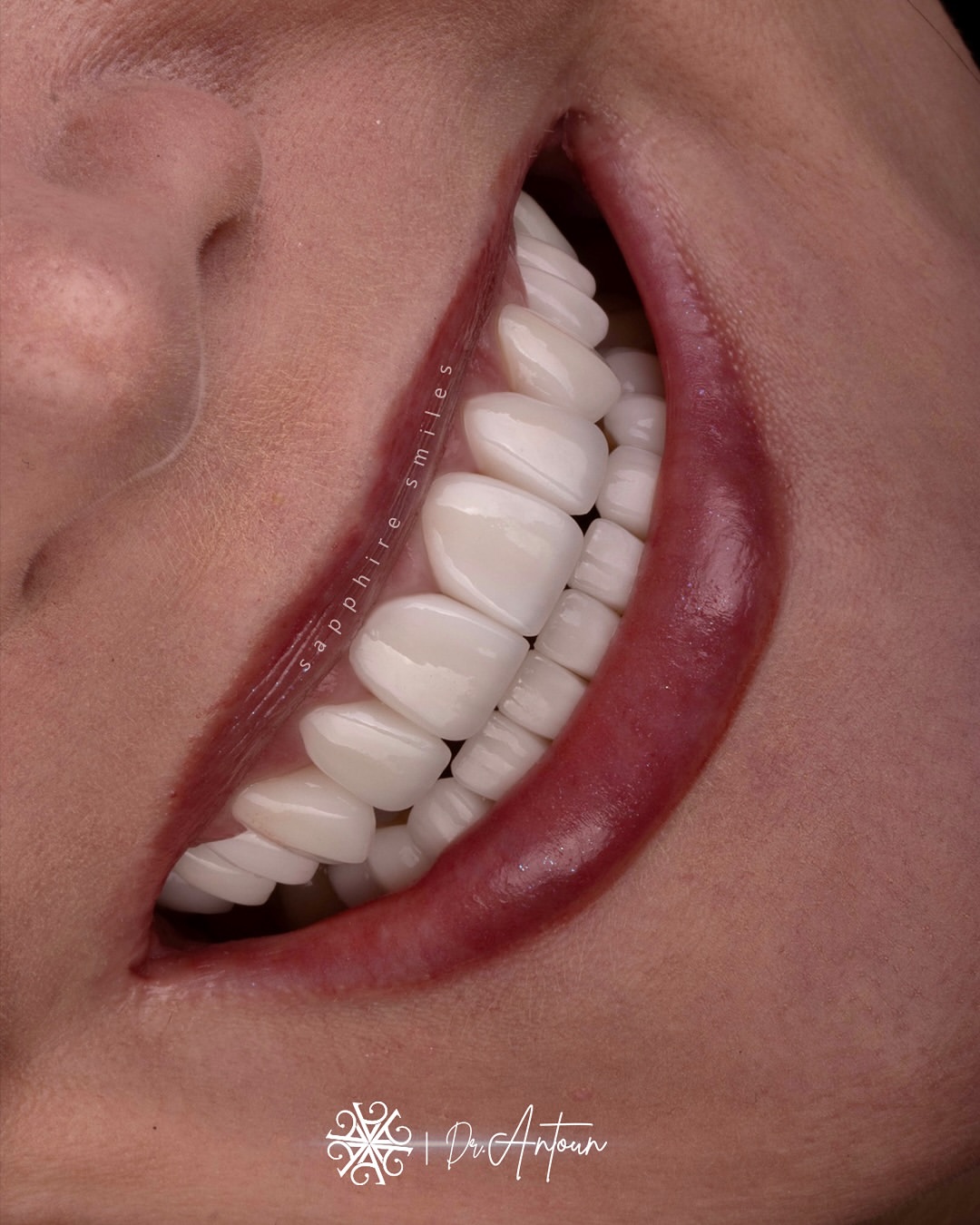 Sapphire Smiles - Dr. Antoun | Leading Cosmetic Dentist in Houston photo 4