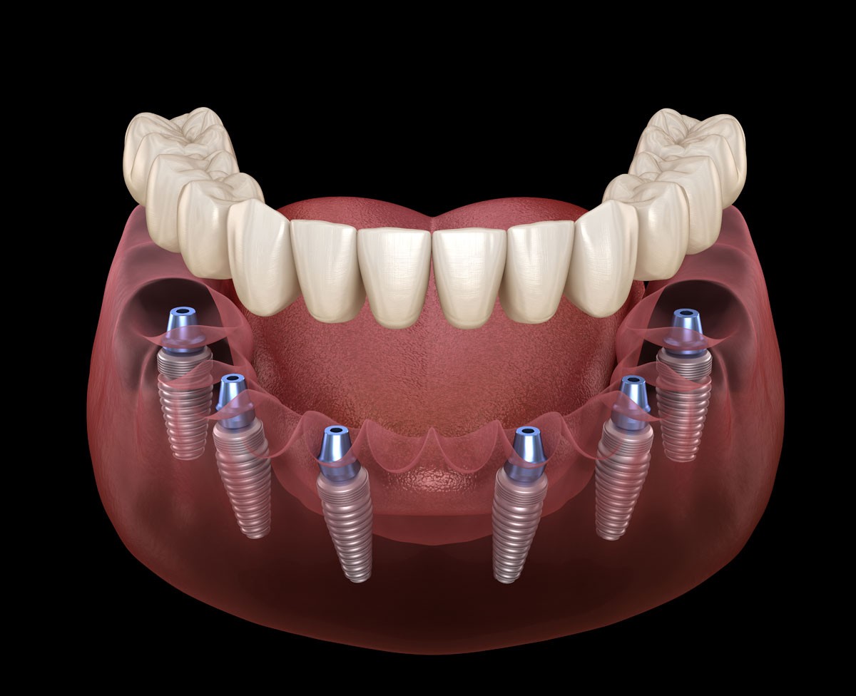 Smart Arches Dental Implants - Bartonsville photo 2
