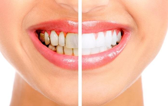 Exclusive Micro Scalp & Teeth Whitening photo 2