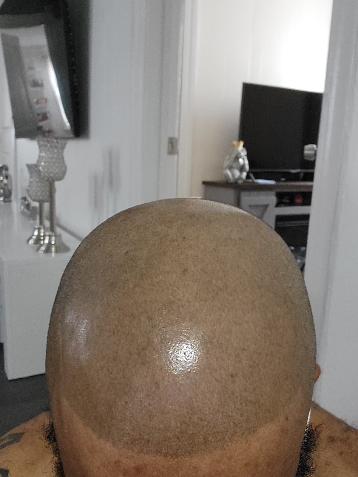 Exclusive Micro Scalp & Teeth Whitening photo 5