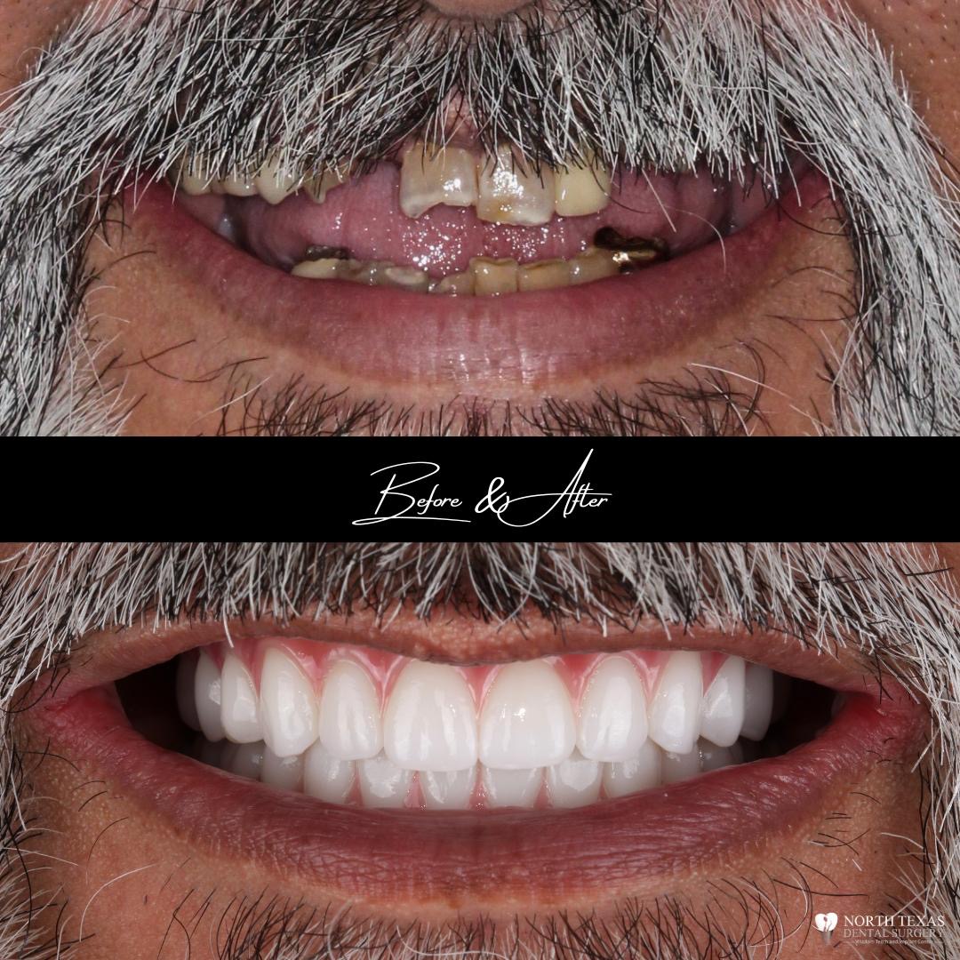 North Texas Dental Surgery Wisdom Teeth And Denture Implant Center photo 2