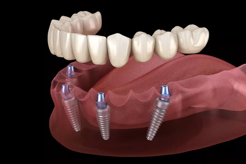 Wellspring Family Dental & Implant Center - Dr. David Butts photo 2