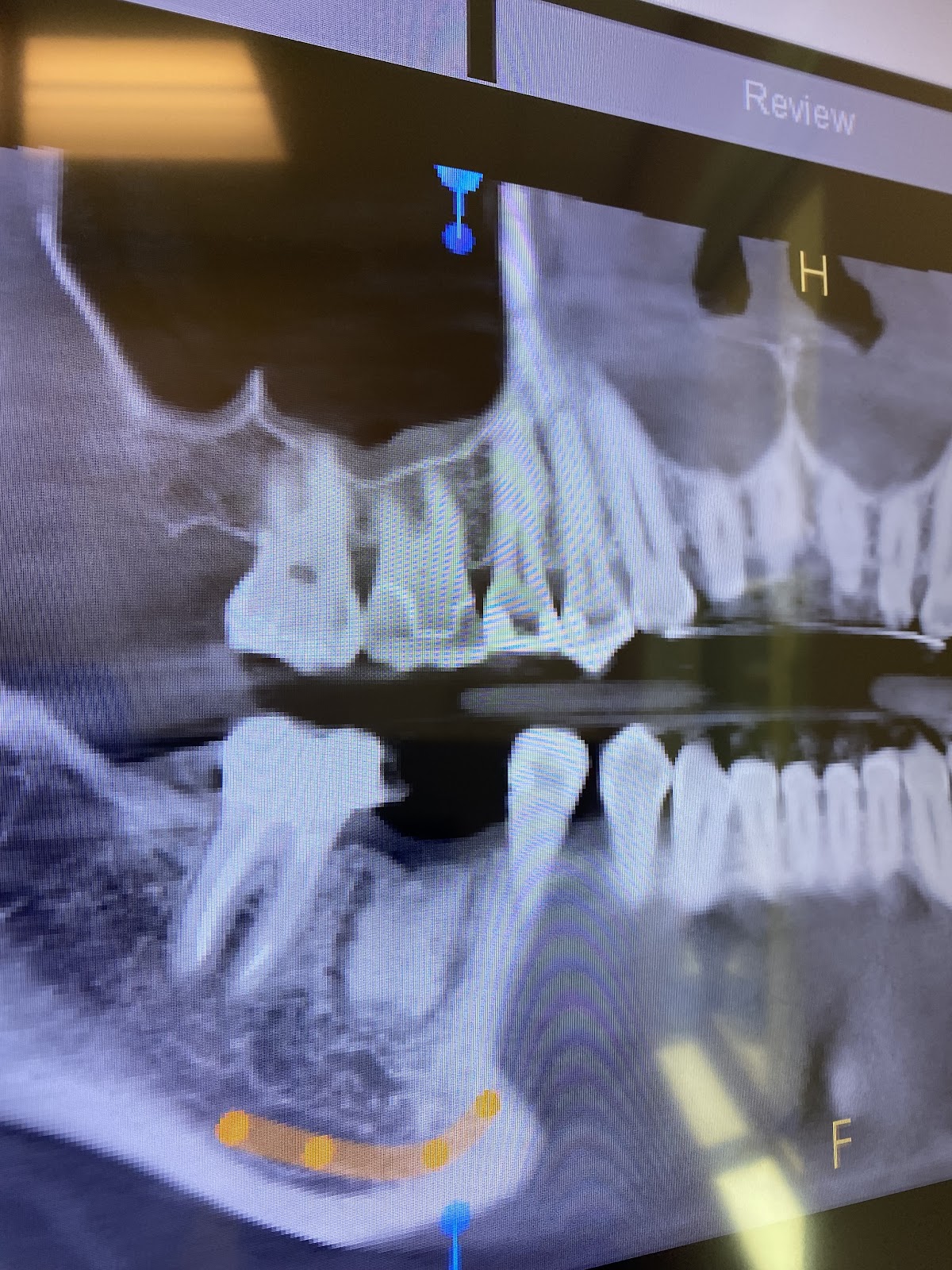 Fresno Oral Maxillofacial Surgery & Dental Implant Center And Wisdom Teeth photo 6