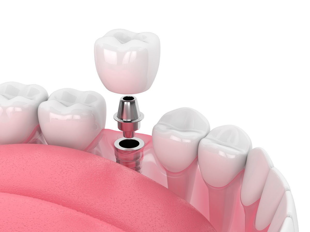 Monterey Coast Periodontics & Implant Dentistry (Carmel Location) photo 3