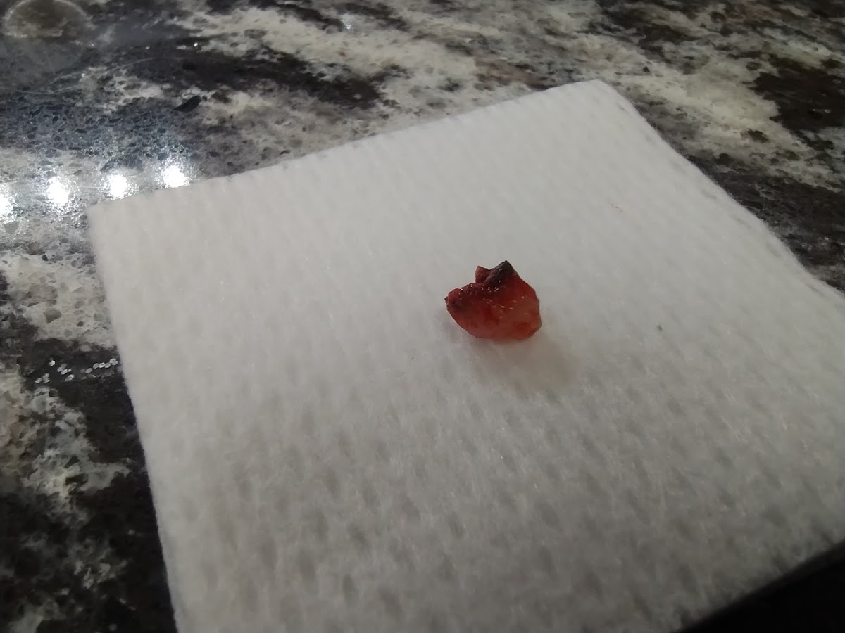Aspen Dental - Angola photo 4