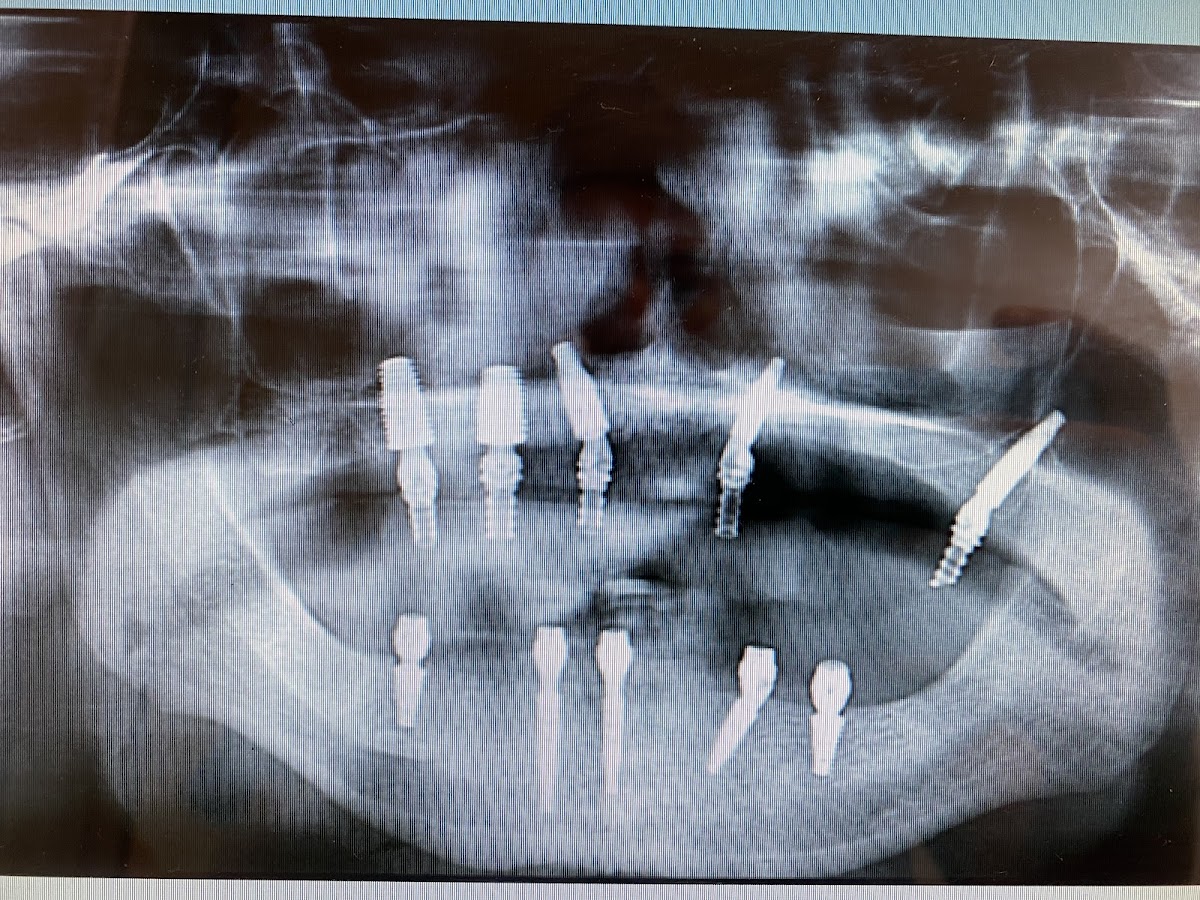 Fusion Dental Implants photo 6
