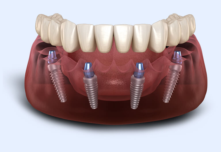 Muench Dental Implants photo 2