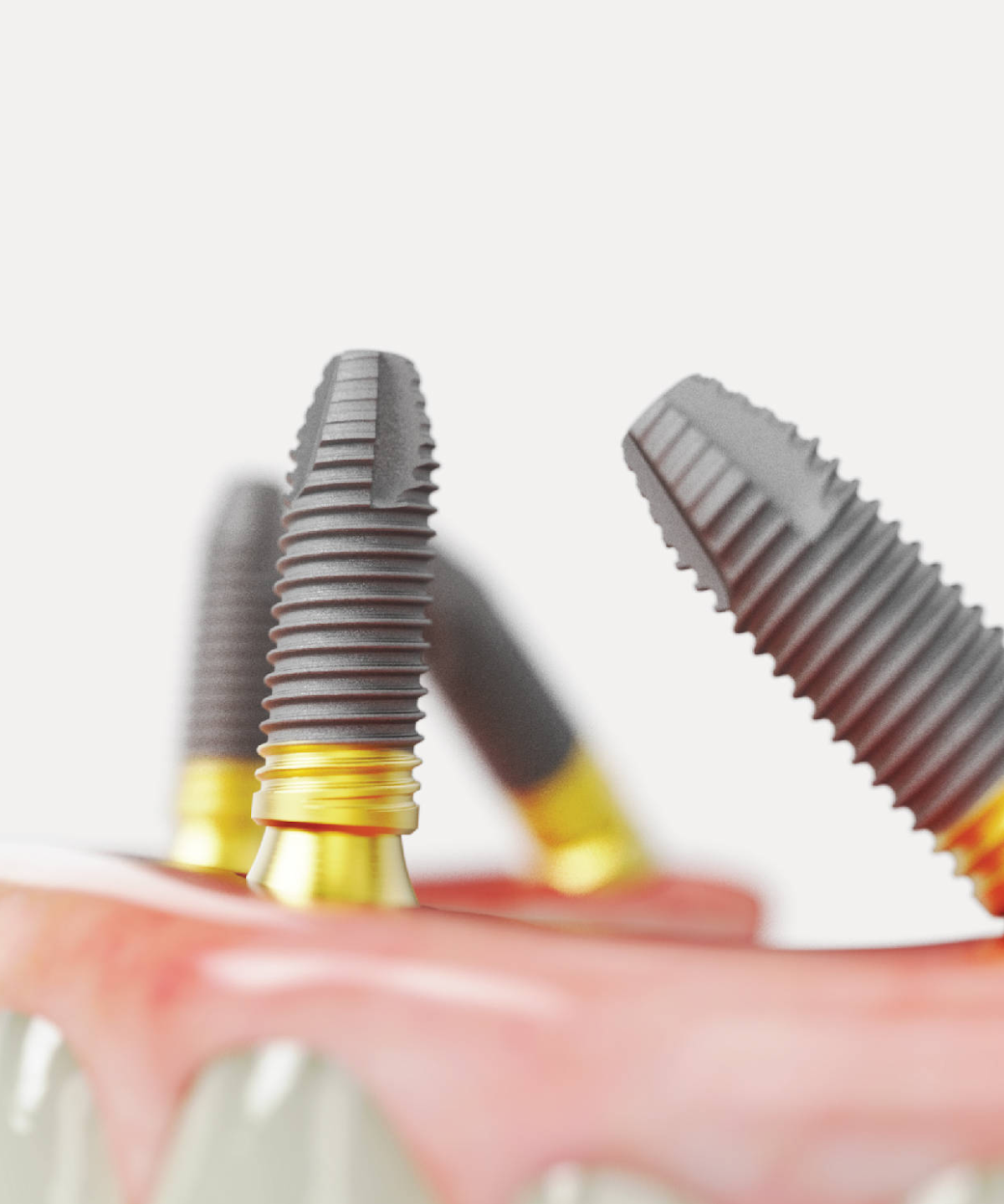 All-on-4 Dental Implants photo 2