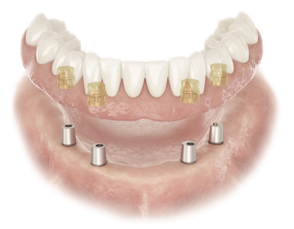 Affordable Dental Implant Excellence/ Implant Dentures/ Tmj and Headaches/ Thomas E. Bramanti, DDS, PHD, Inc photo 3