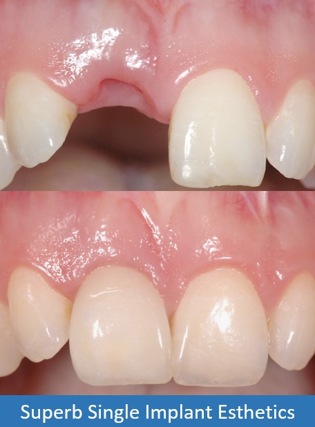 Affordable Dental Implant Excellence/ Implant Dentures/ Tmj and Headaches/ Thomas E. Bramanti, DDS, PHD, Inc photo 4