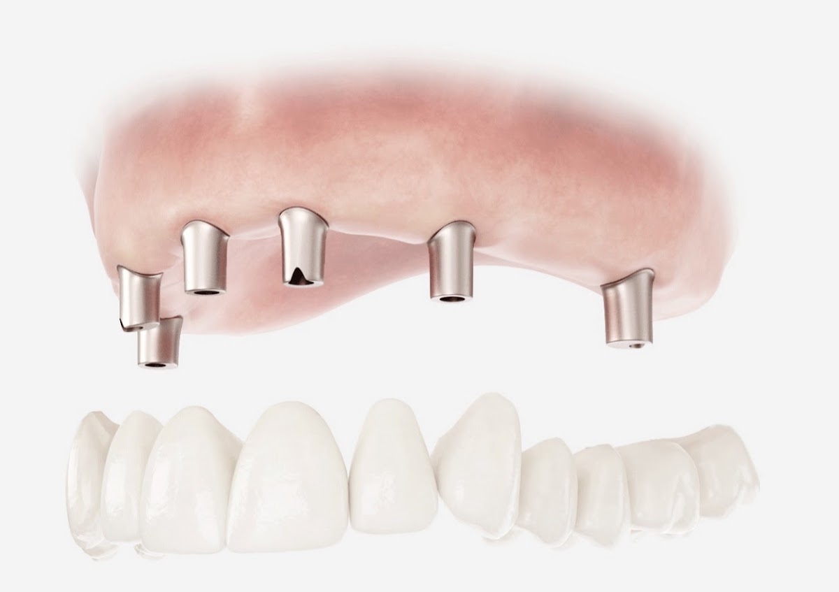 Affordable Dental Implant Excellence/ Implant Dentures/ Tmj and Headaches/ Thomas E. Bramanti, DDS, PHD, Inc photo 6
