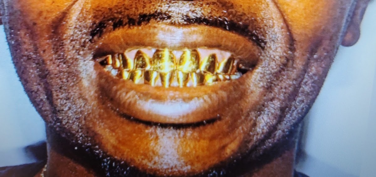 Coral Springs Smiles | Dentist Coral Springs | Emergency & Cosmetic Dentist, Periodontics and Implant Dentistry photo 6
