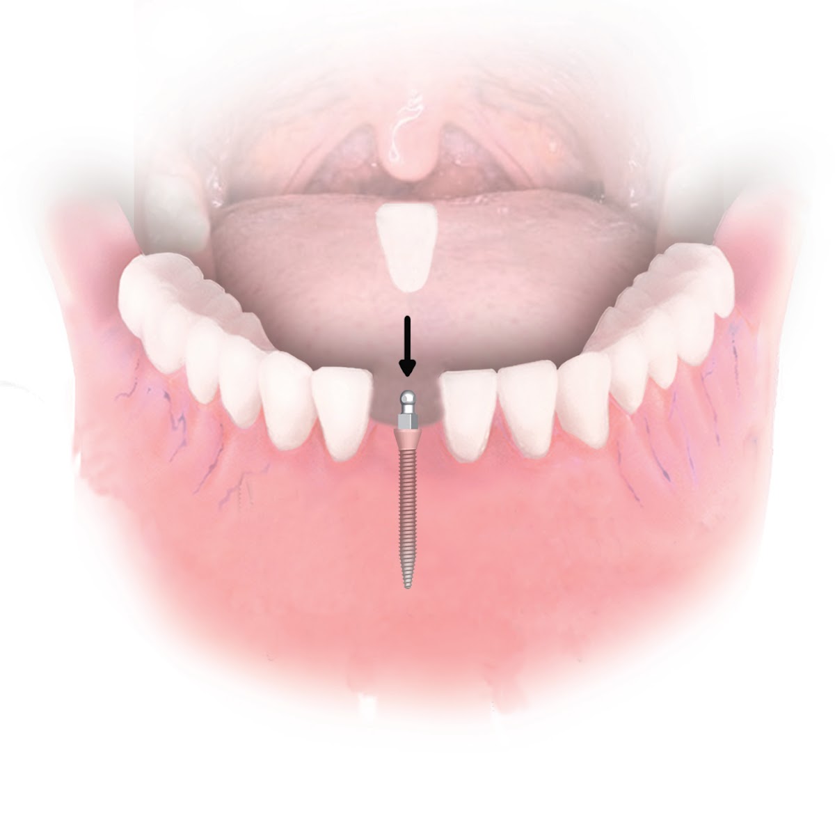 Dental Implant Solutions Prestonsburg, Ky photo 4