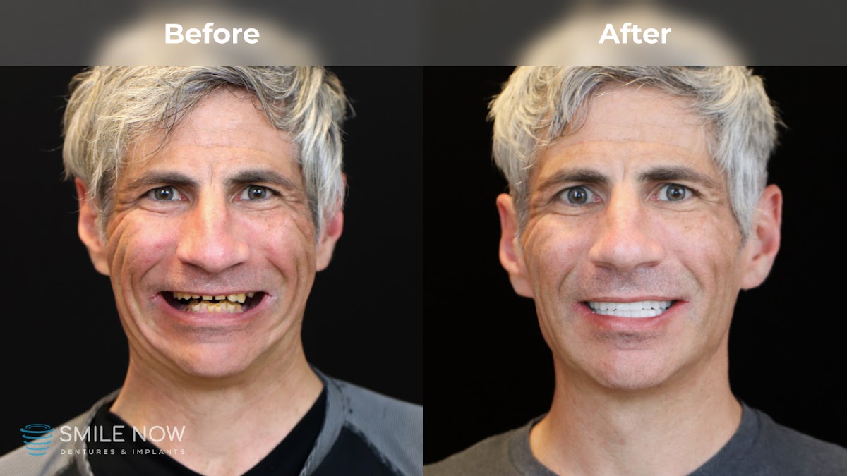Smile Now Reno Dentures and Implants photo 3
