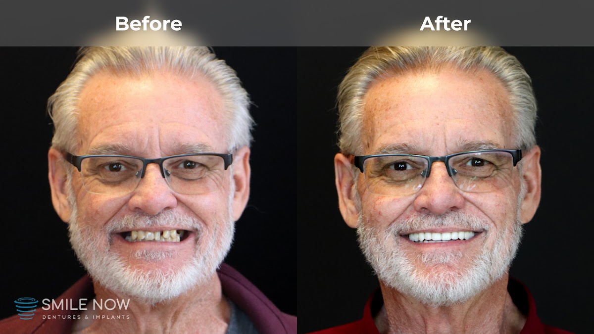 Smile Now Reno Dentures and Implants photo 5