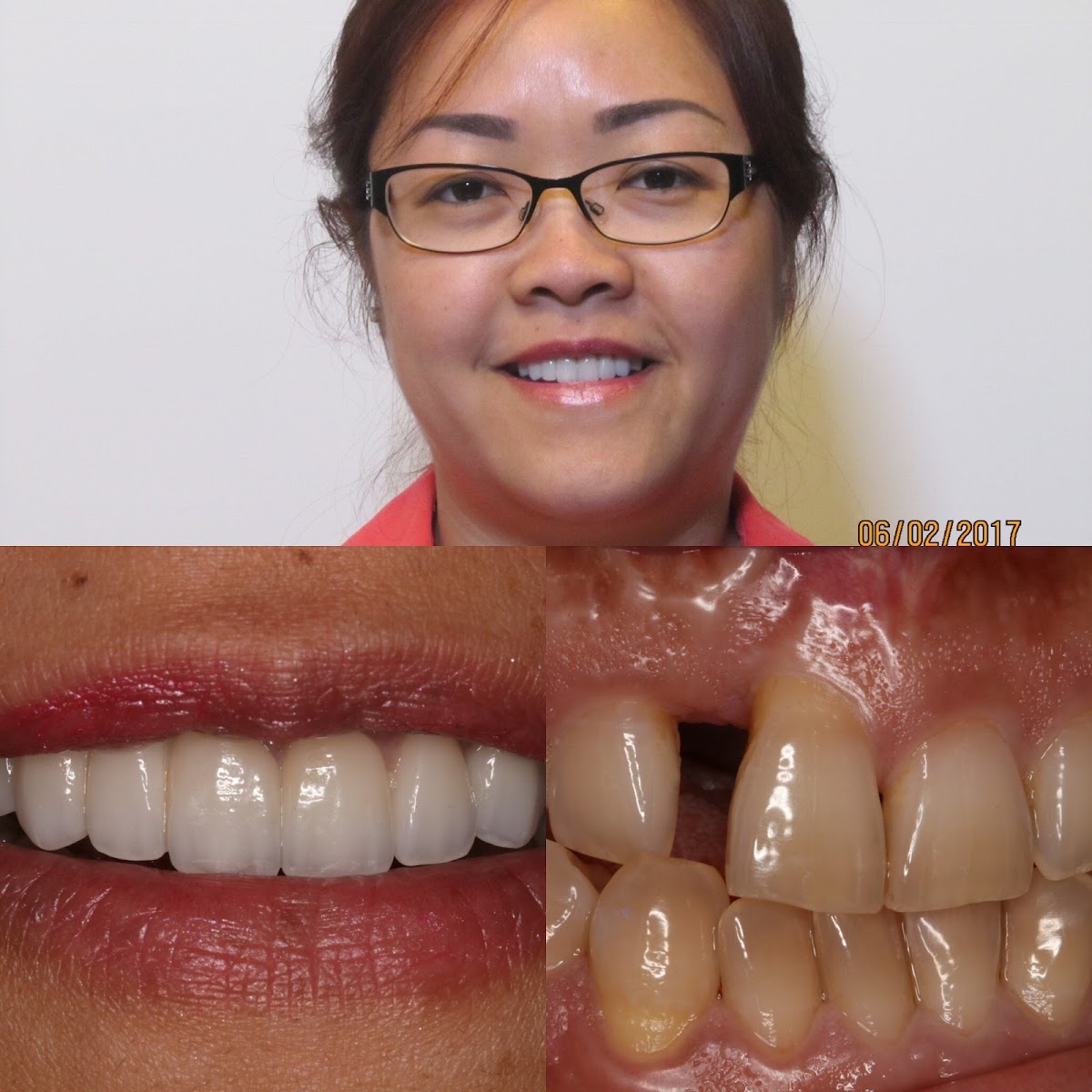 Elite Smiles Dental, Invisalign, Implants, Cosmetic Dentistry- Dr. Anatoliy Ravin- Dentist photo 5