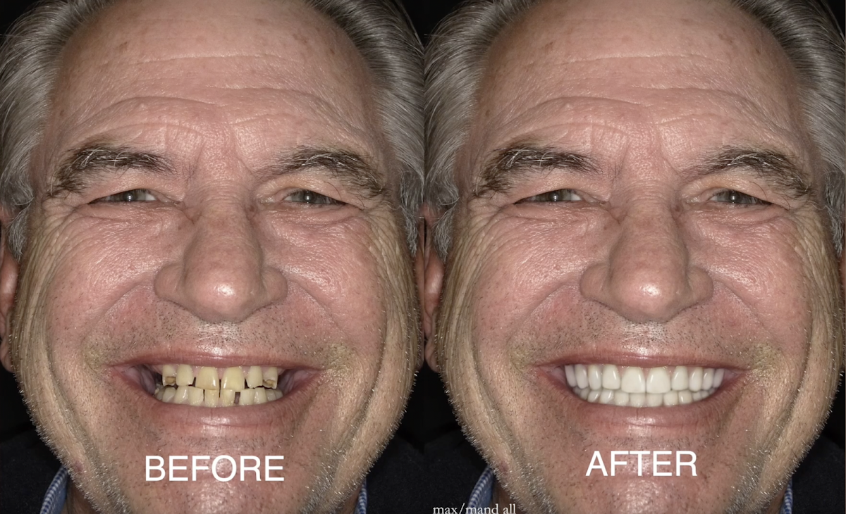 All On 5 Dental Implants photo 4