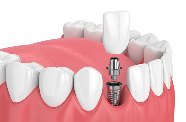 Sunrise Dental Sequim photo 6