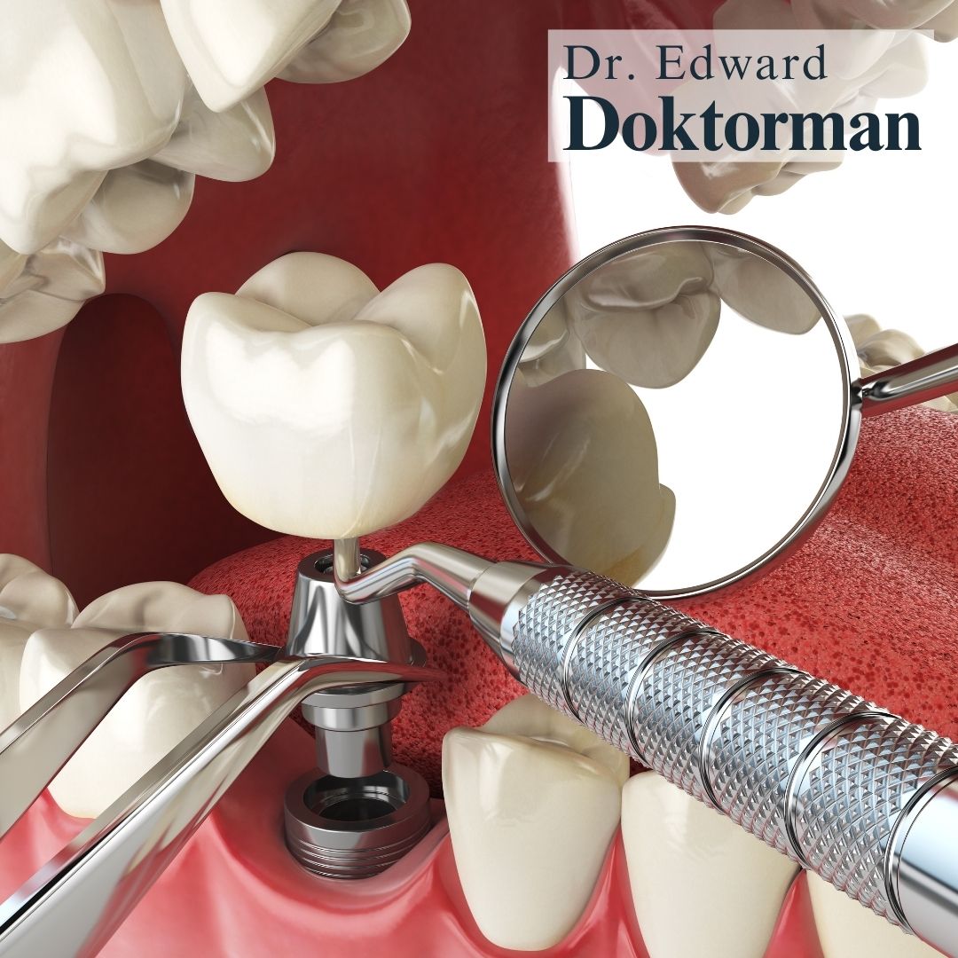 Affordable Dental Implants Clifton photo 3