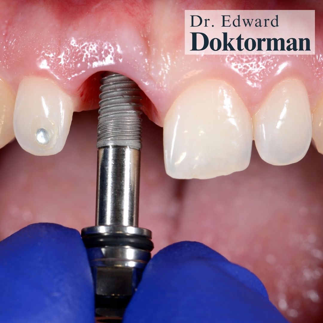 Affordable Dental Implants Clifton photo 6
