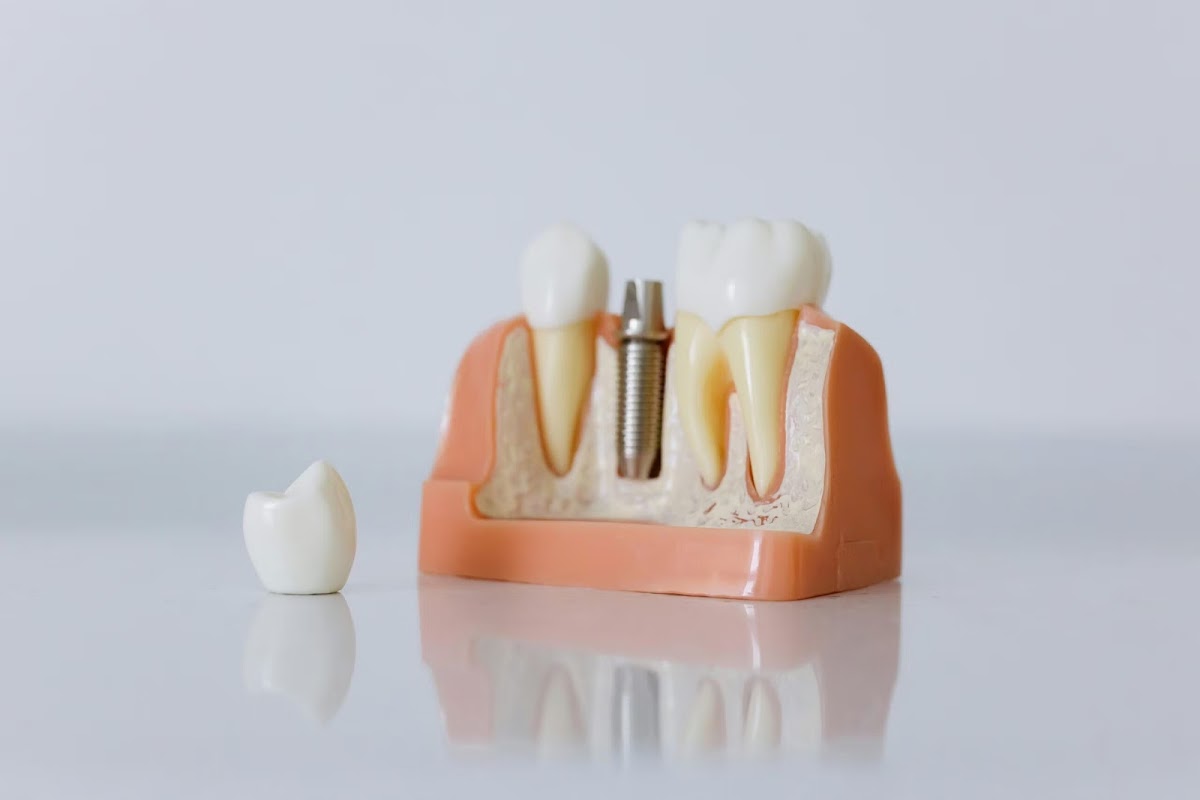 Dental Implants St. Lucie County photo 6