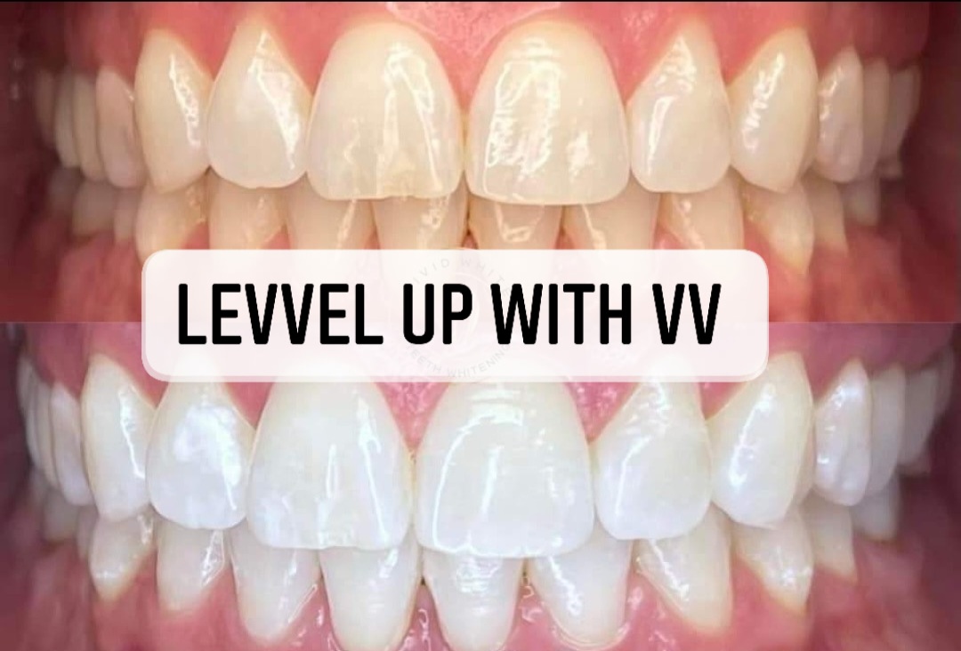 Levvel up With Vv Tooth Gems ,teeth Whitening & More photo 1