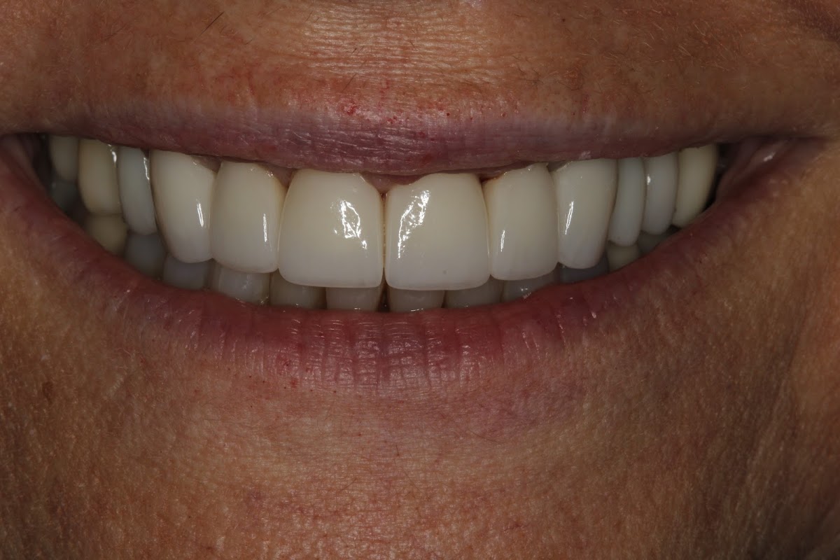 Dental Implants Miami Beach: Dr. Howard Abrahams, DMD, Mscd photo 3