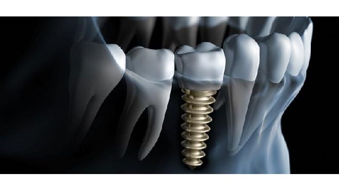 Oxnard Wisdom Teeth photo 1