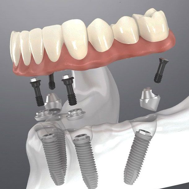 Stubbs Dental Implant Center photo 5