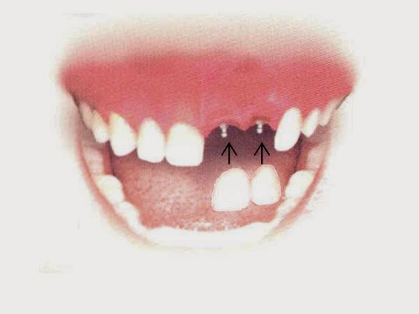 Dental Implant Solutions Summerfield, Fl photo 1