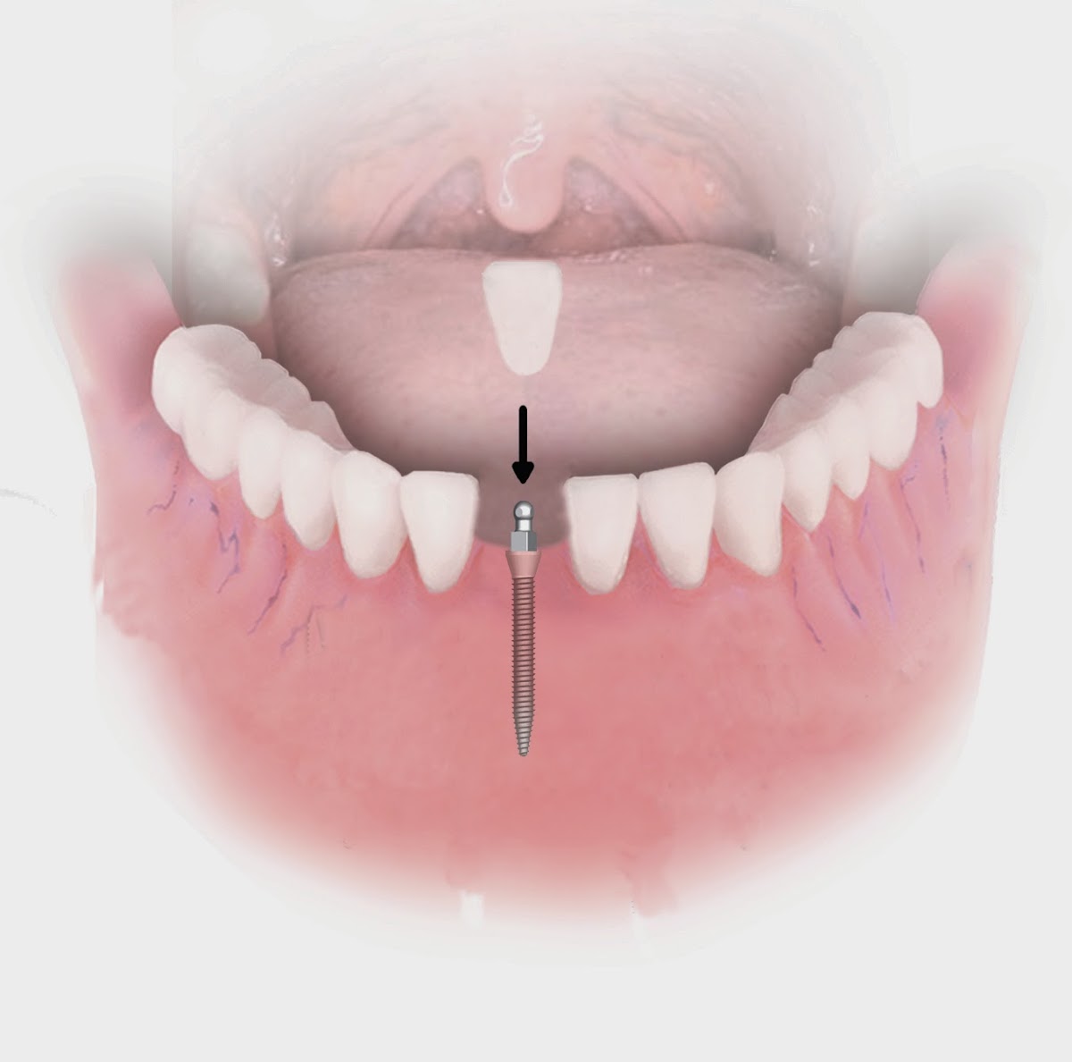 Dental Implant Solutions Summerfield, Fl photo 2