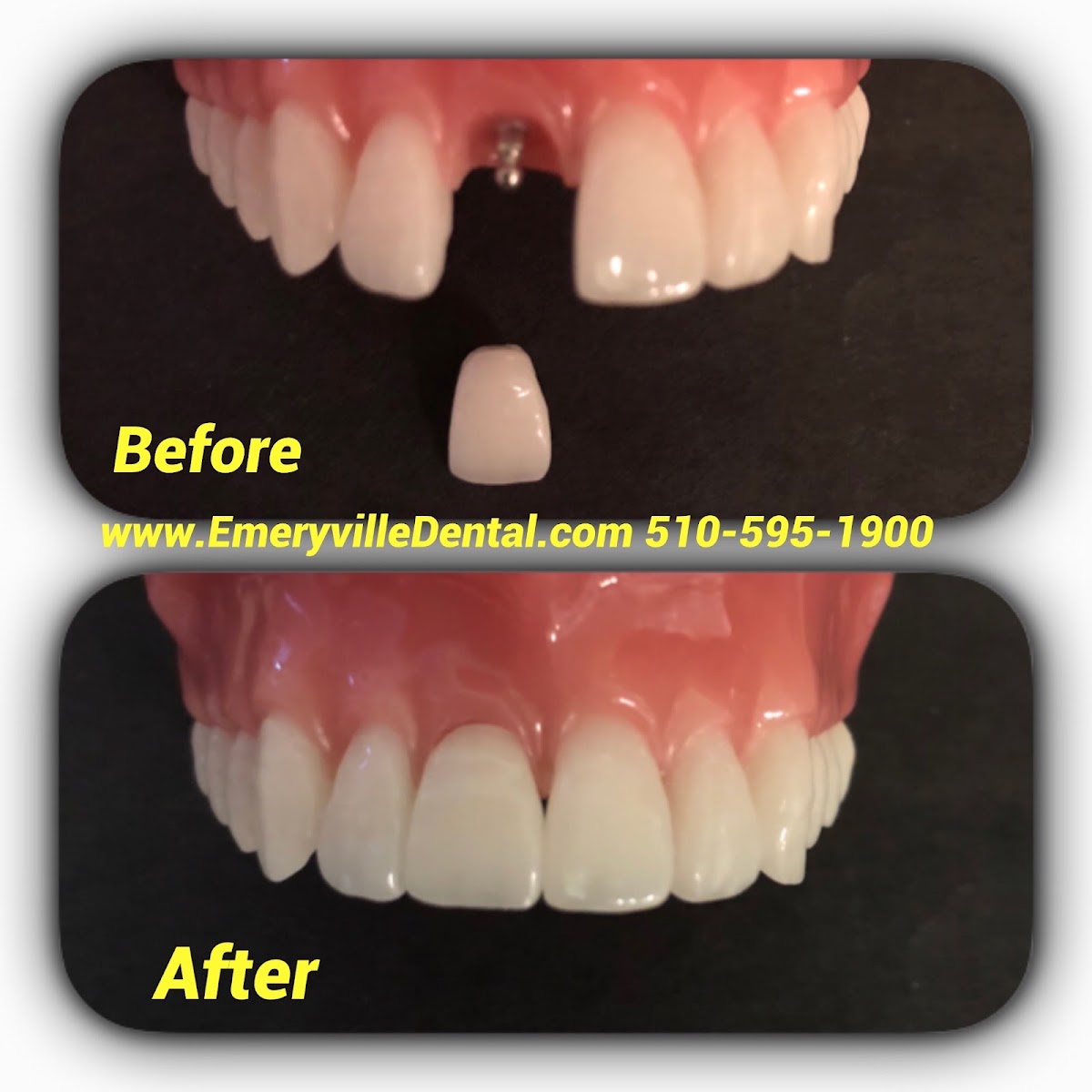 Emeryville Dental Care Mini Dental Implant Center photo 5