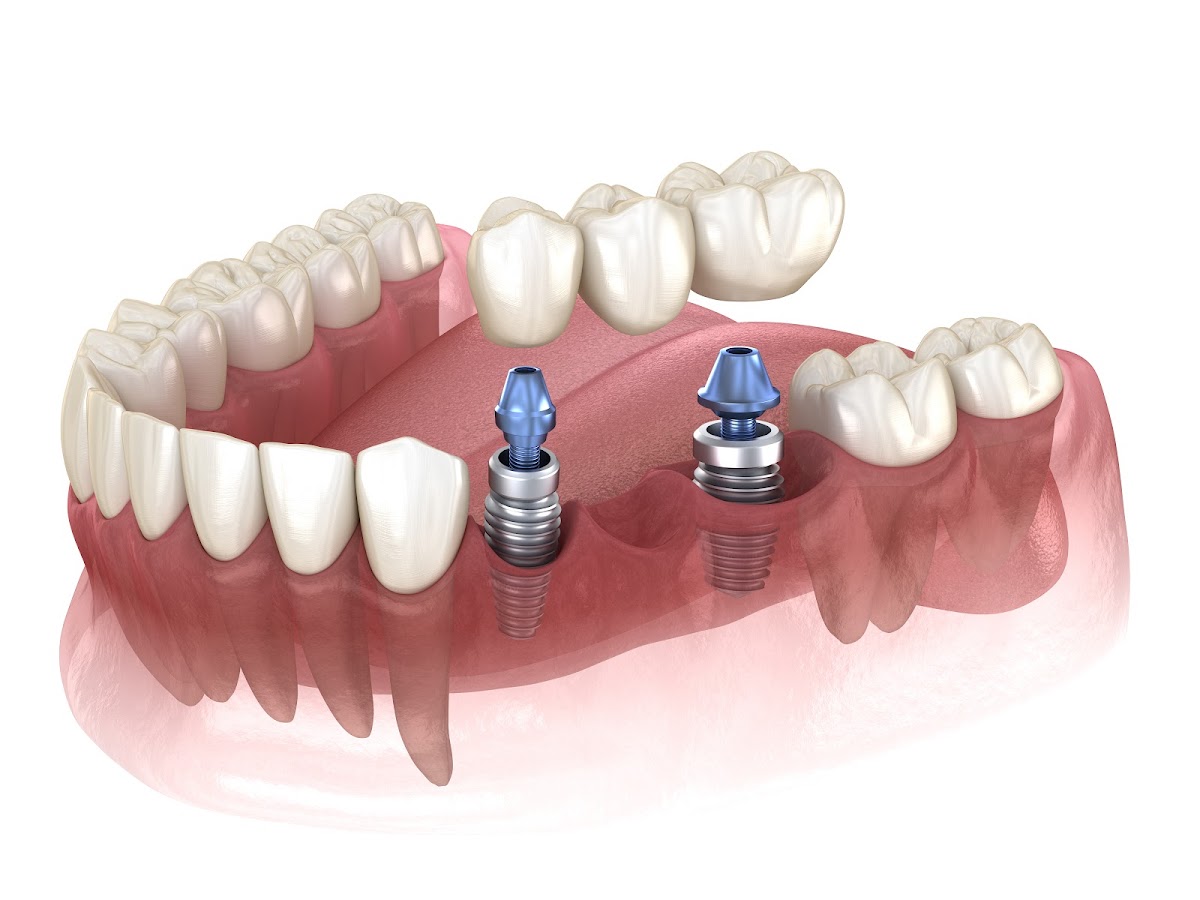 Advanced Dental Implant and Tmj Center photo 3