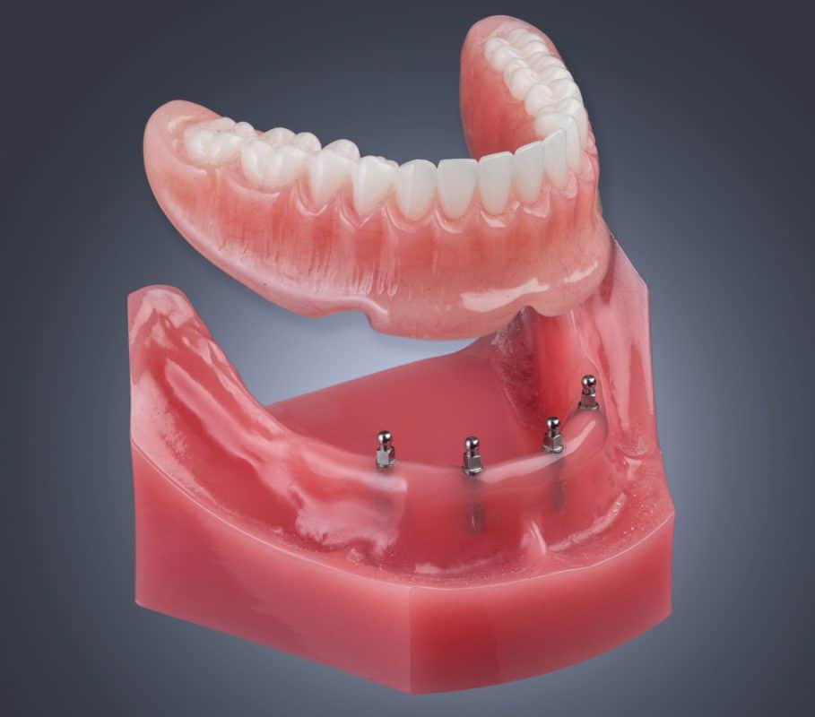 Mini Dental Implant Centers of America - Colorado Springs, Co photo 1