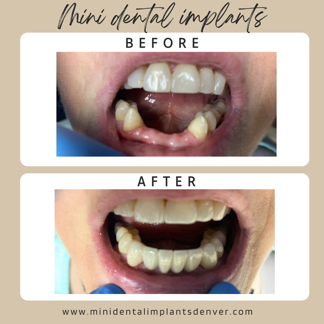 Mini Dental Implant Centers of America - Colorado Springs, Co photo 2