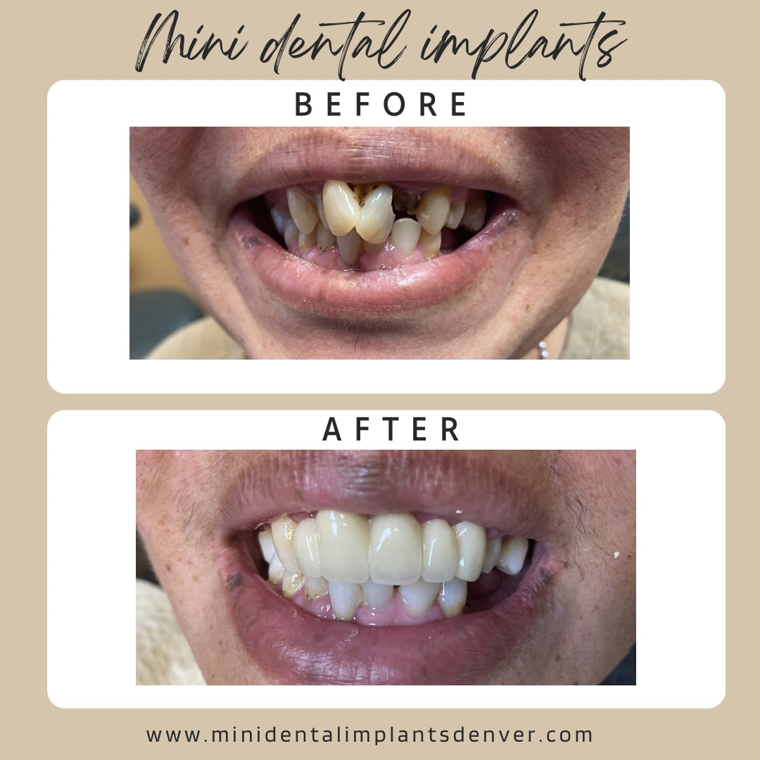 Mini Dental Implant Centers of America - Colorado Springs, Co photo 6
