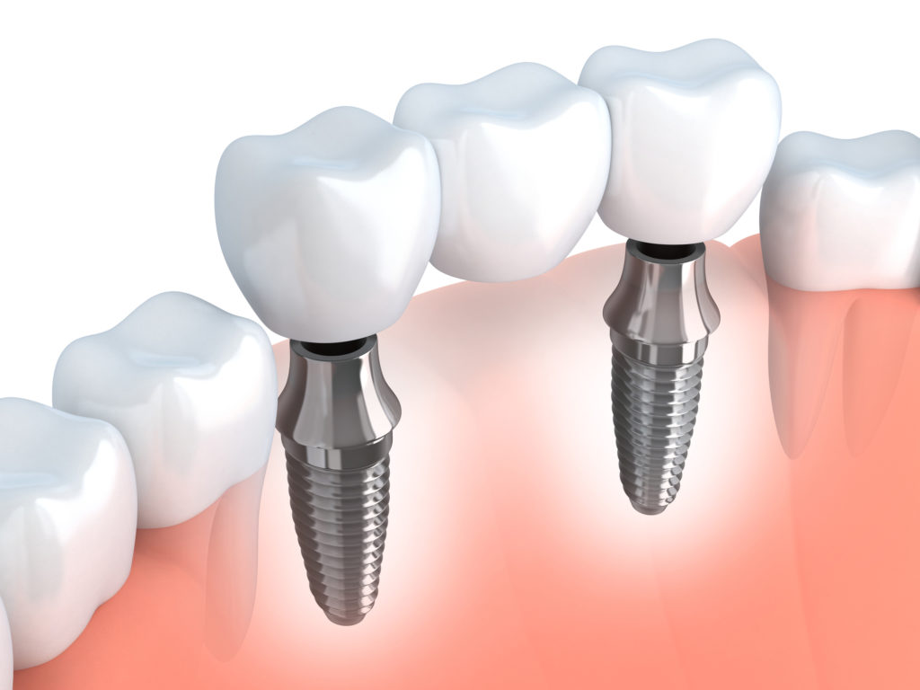 Bismarck Advanced Dental and Implants photo 2