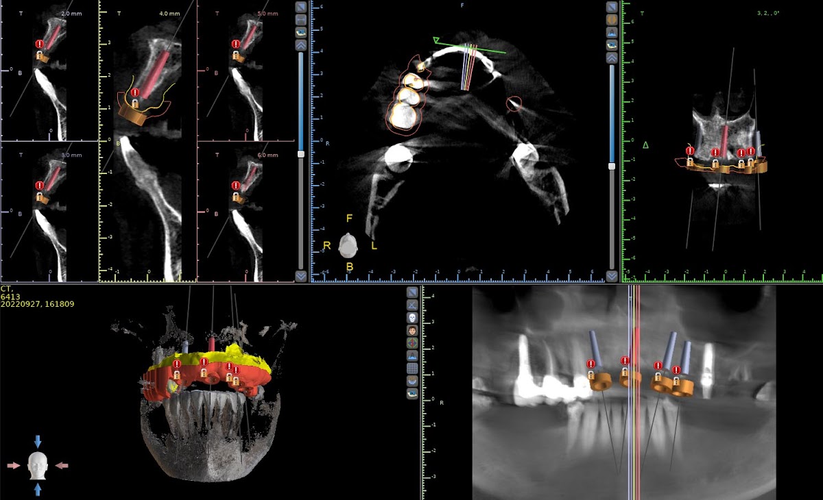 5 Minute Implants photo 3