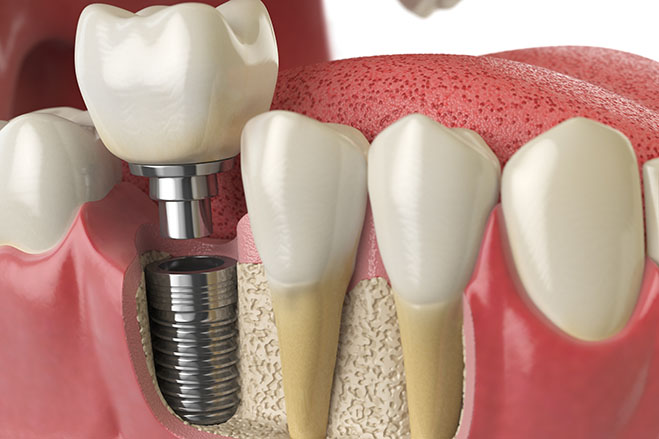 Quality Dentures and Implants photo 4