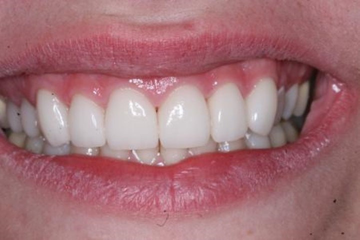 Elite Dental American Fork | Dentist & Implants photo 5