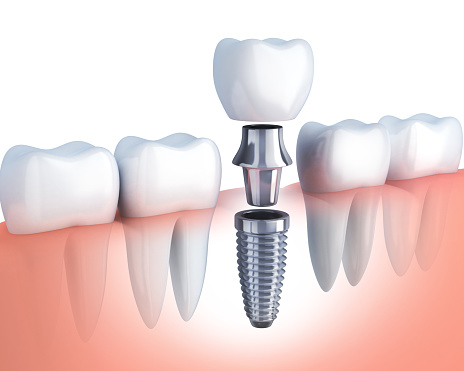 Whitlow Dental Care - Dental Implant Center photo 4